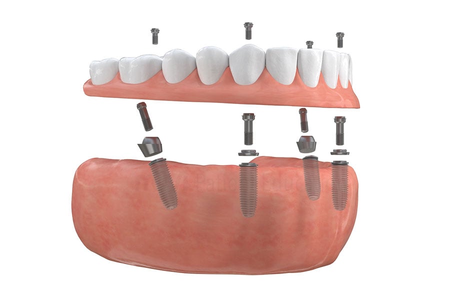 Dental Implants