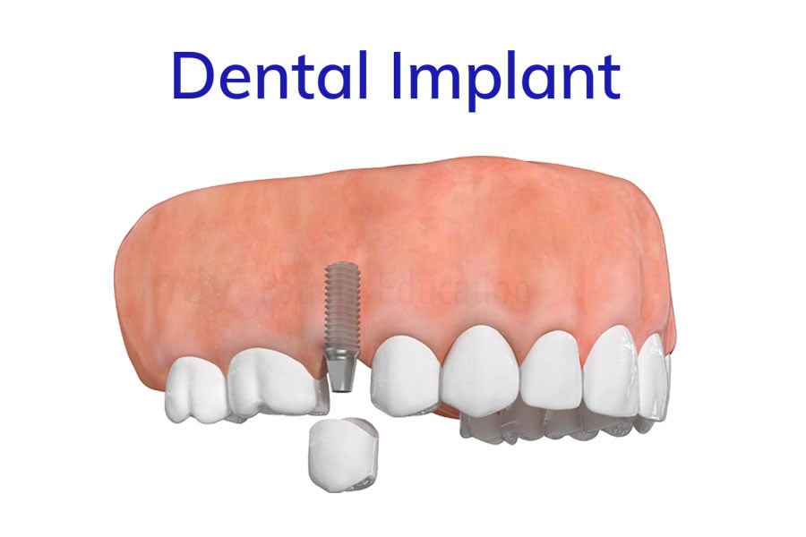 Dental Implants