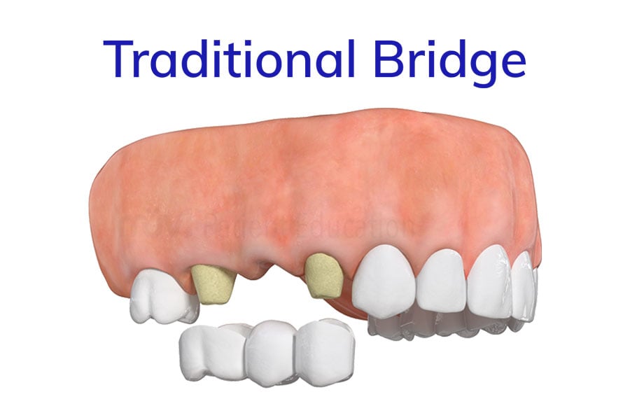 Dental Bridge
